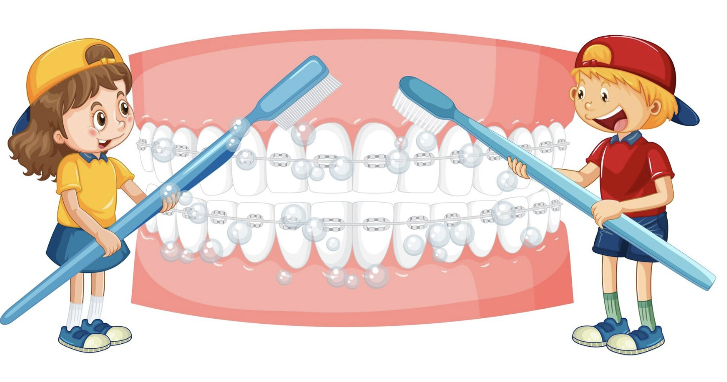 How Do I Care For My Teeth While Wearing Braces?